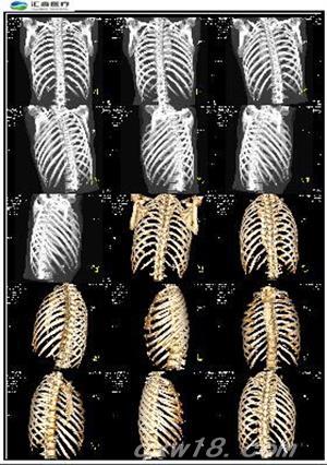 Kooka A医用高清胶片